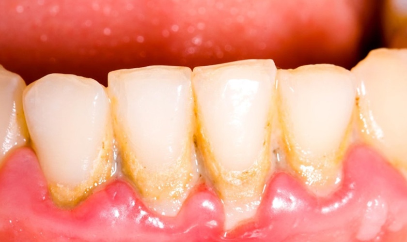 Việc vệ sinh răng miệng không tốt sẽ hình thành nên các mảng bám tạo thành vôi răng