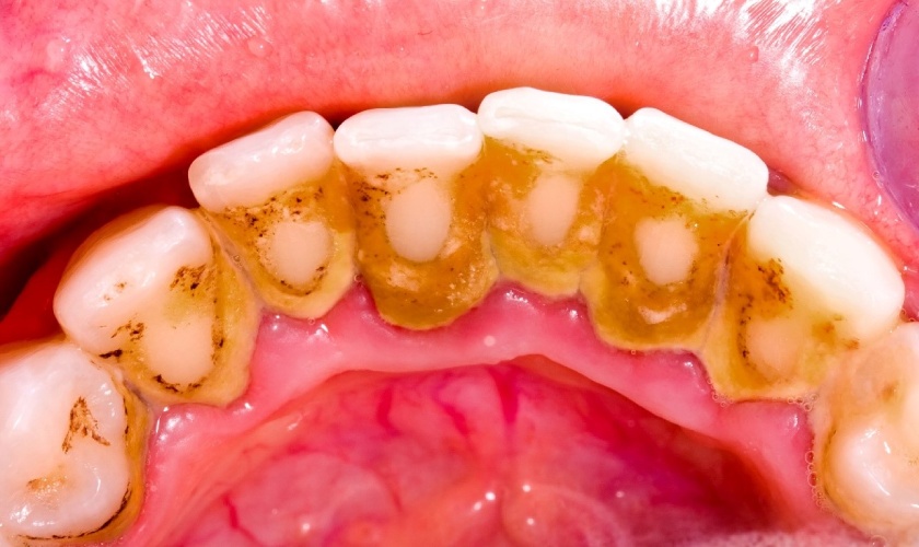 Vôi răng có thể hình thành nên bệnh viêm nướu