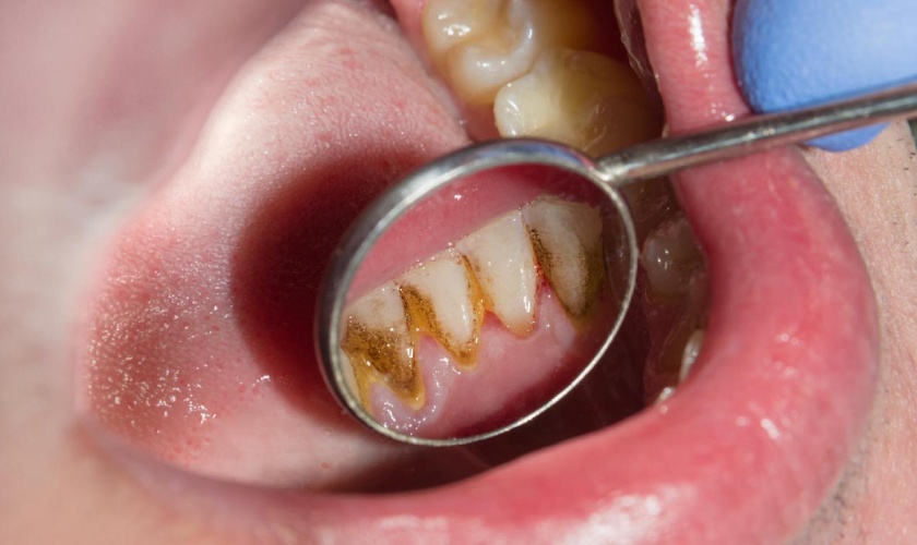 Vôi răng là những mảng bám tích tụ lâu ngày và bám vững chắc trên răng