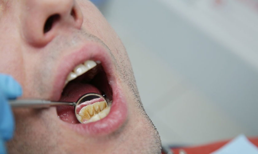 Vôi răng là nguyên nhân hàng đầu gây nên các bệnh về răng miệng