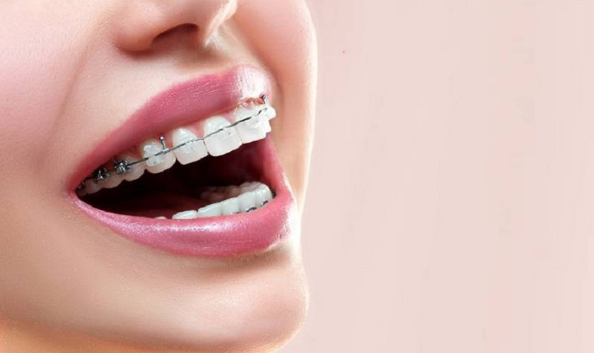 Niềng răng thẩm mỹ là giải pháp tối ưu giúp bạn có được hàm răng đều hạt bắp