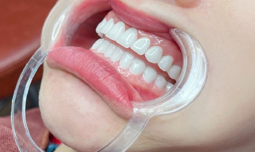 Răng sứ thẩm mỹ giúp bạn có được hàm răng đều đẹp trong thời gian ngắn