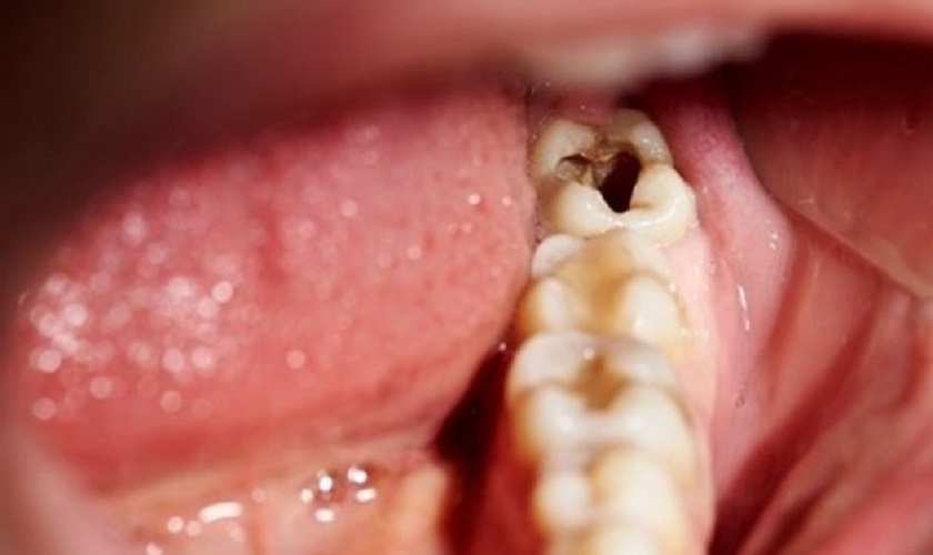 Sâu răng khôn là tình trạng rất thường gặp