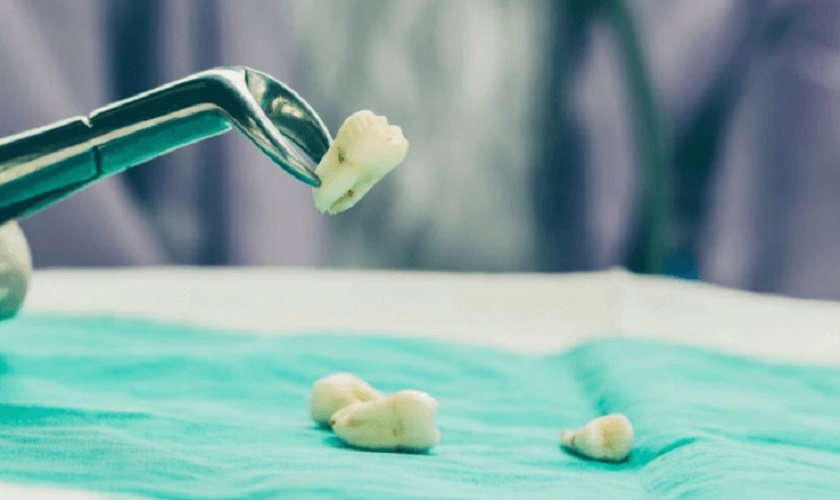 Nhổ răng là biện pháp thường được chỉ định để xử lý răng số 8 bị sâu